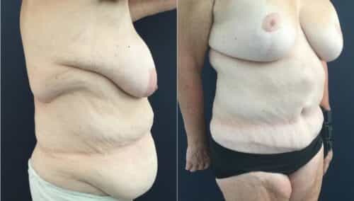 tummy tuck colombia 322-3-min