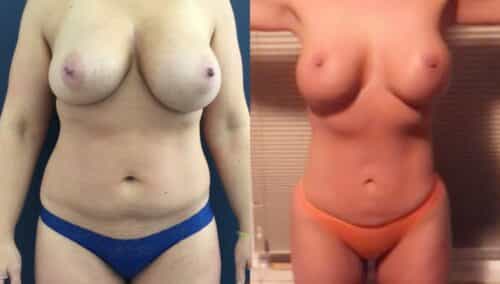 tummy tuck colombia 327-1-min