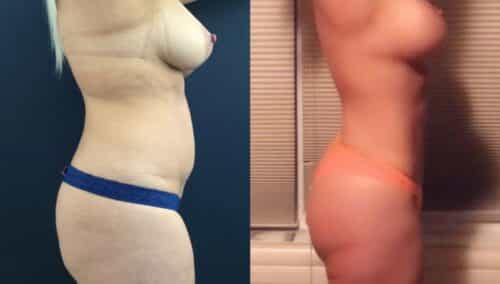 tummy tuck colombia 327-2-min