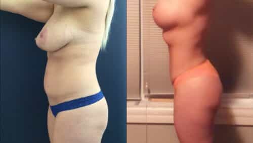 tummy tuck colombia 327-3-min