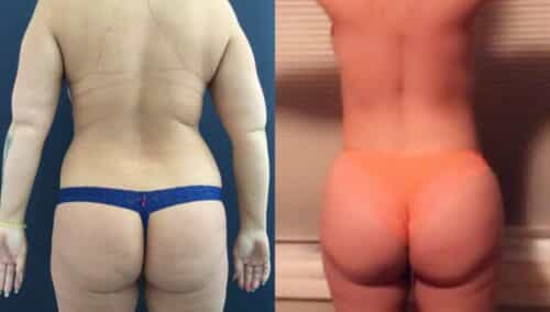 tummy tuck colombia 327-4-min