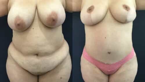 tummy tuck colombia 334-1-min