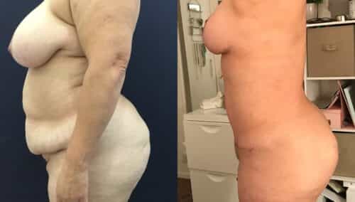 tummy tuck colombia 334-2-min