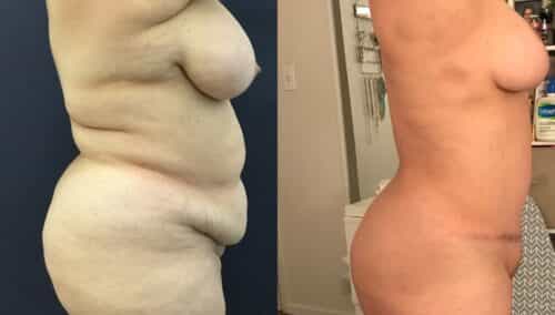 tummy tuck colombia 334-3-min