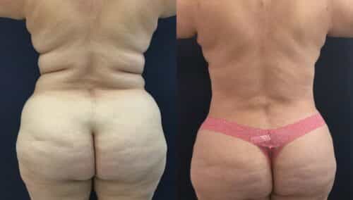 tummy tuck colombia 334-4-min