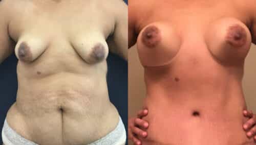 tummy tuck colombia 342-1-min