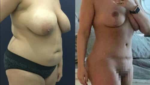 tummy tuck colombia 349-1-min