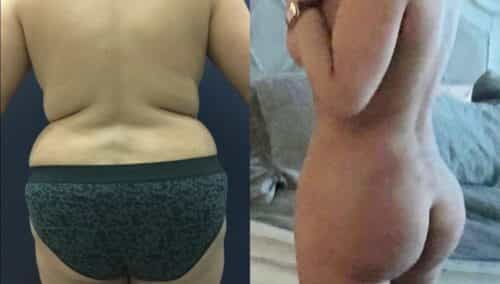 tummy tuck colombia 349-2-min