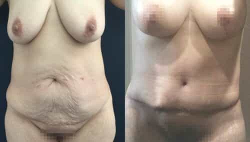tummy tuck colombia 354-1-min