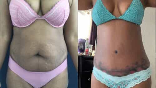tummy tuck colombia 355-1-min