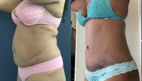 tummy tuck colombia 355-2-min