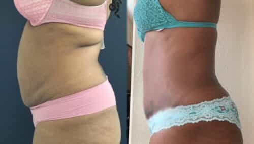tummy tuck colombia 355-3-min