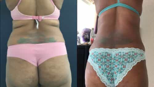 tummy tuck colombia 355-4-min