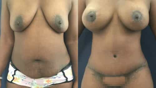 tummy tuck colombia 356-1-min