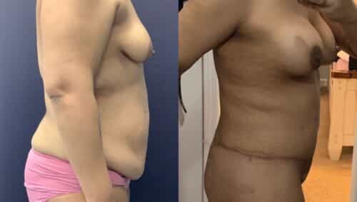 tummy tuck colombia 360-2-min