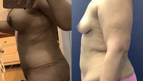 tummy tuck colombia 360-3-min
