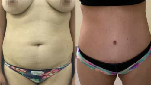 tummy tuck colombia 361-1-min