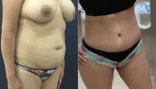 tummy tuck colombia 361-2-min