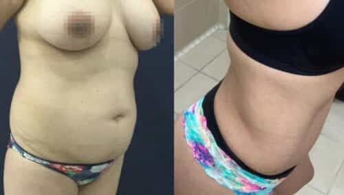 tummy tuck colombia 361-3-min