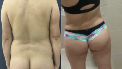 tummy tuck colombia 361-4-min