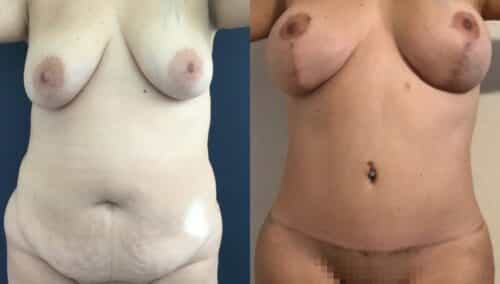 tummy tuck colombia 364-1-min