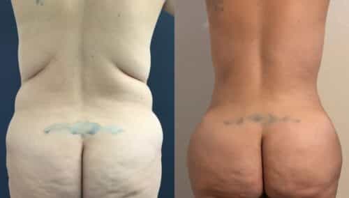 tummy tuck colombia 364-2-min