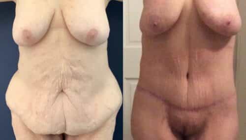 tummy tuck colombia 368-1-min