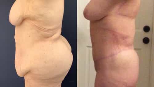 tummy tuck colombia 368-2-min