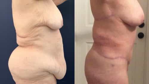 tummy tuck colombia 368-3-min