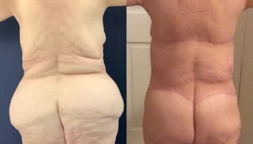 tummy tuck colombia 368-4-min