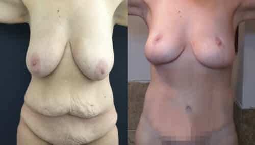tummy tuck colombia 389-1-min