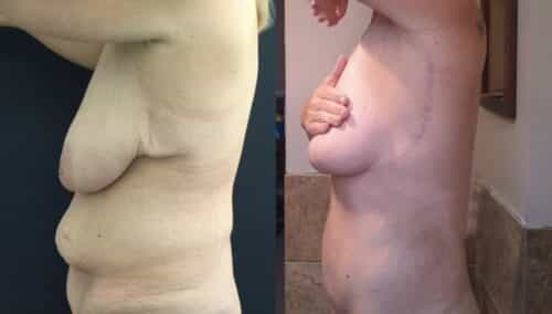 tummy tuck colombia 389-2-min