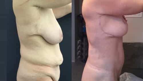 tummy tuck colombia 389-3-min