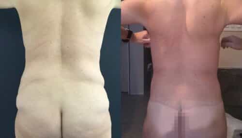 tummy tuck colombia 389-4-min