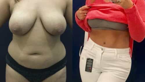 tummy tuck colombia 598-1-min